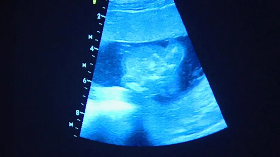 Vyšetření na ultrazvuku