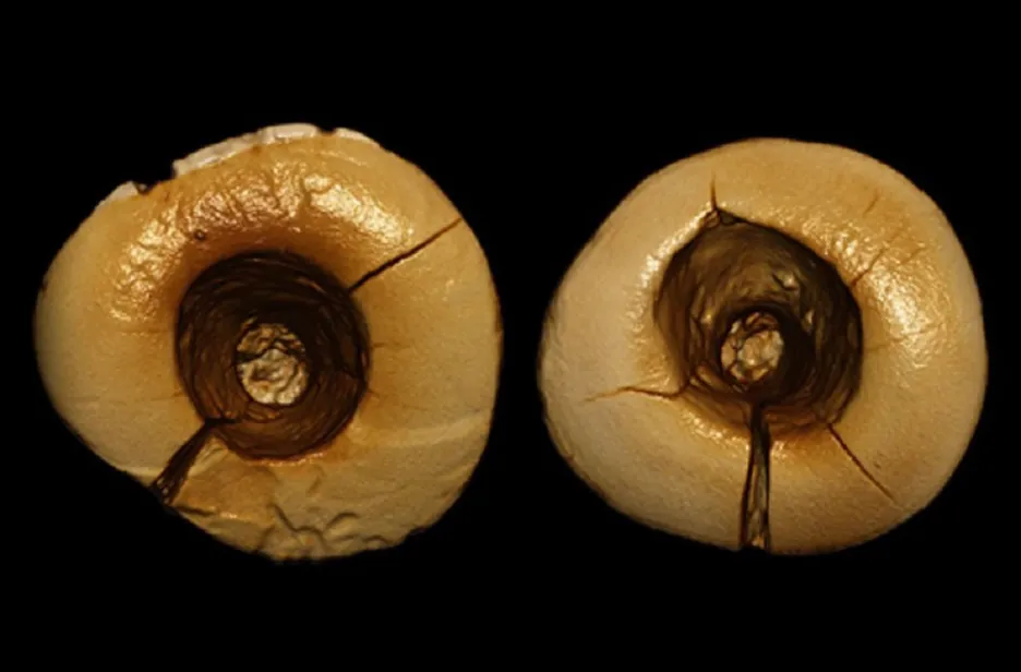 Zubařský krok starý tisíce let