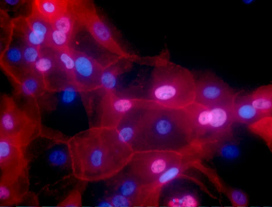 Buňky rakoviny prsu