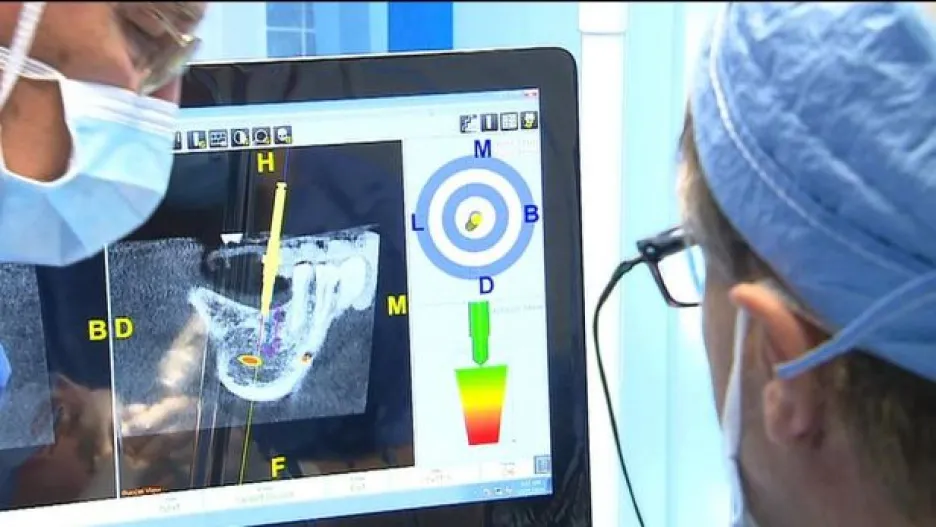 Video V Kladně vyzkoušeli bezbolestnou zubní transplantaci