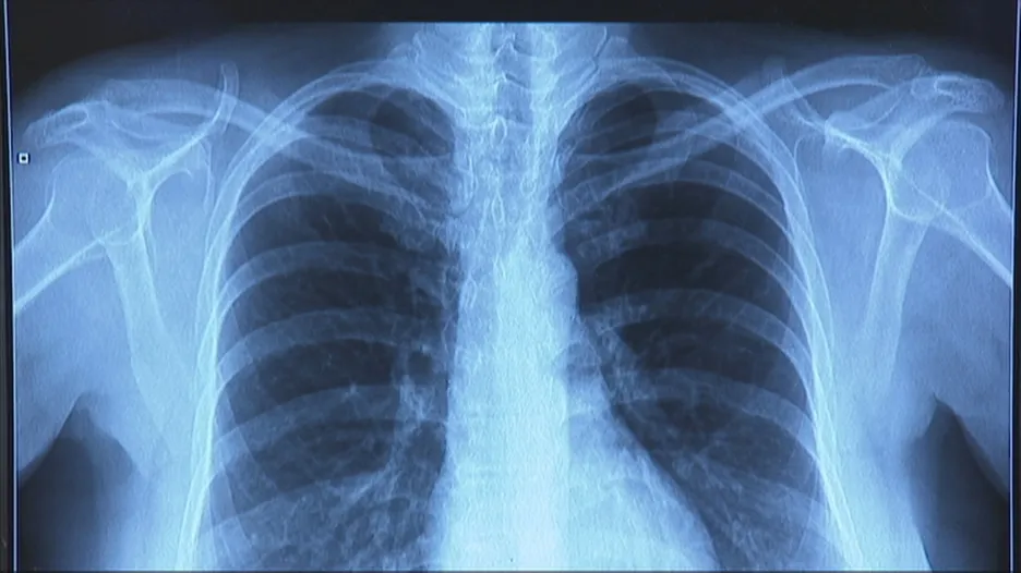 Plíce s plicní fibrózou