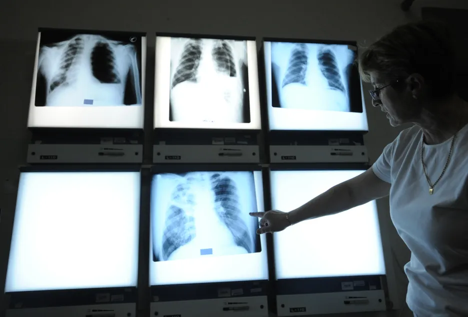 Rentgenové snímky plic s tuberkulózou