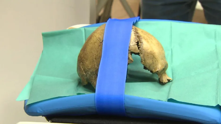 Žižkova lebka - CT vyšetření v Nemocnici Tábor