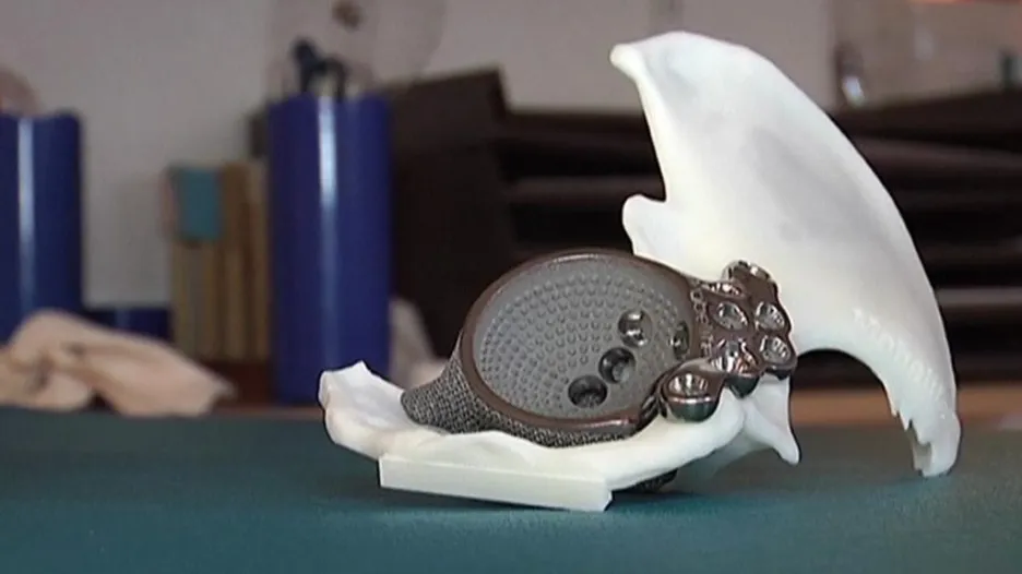 Implantát z 3D tiskárny