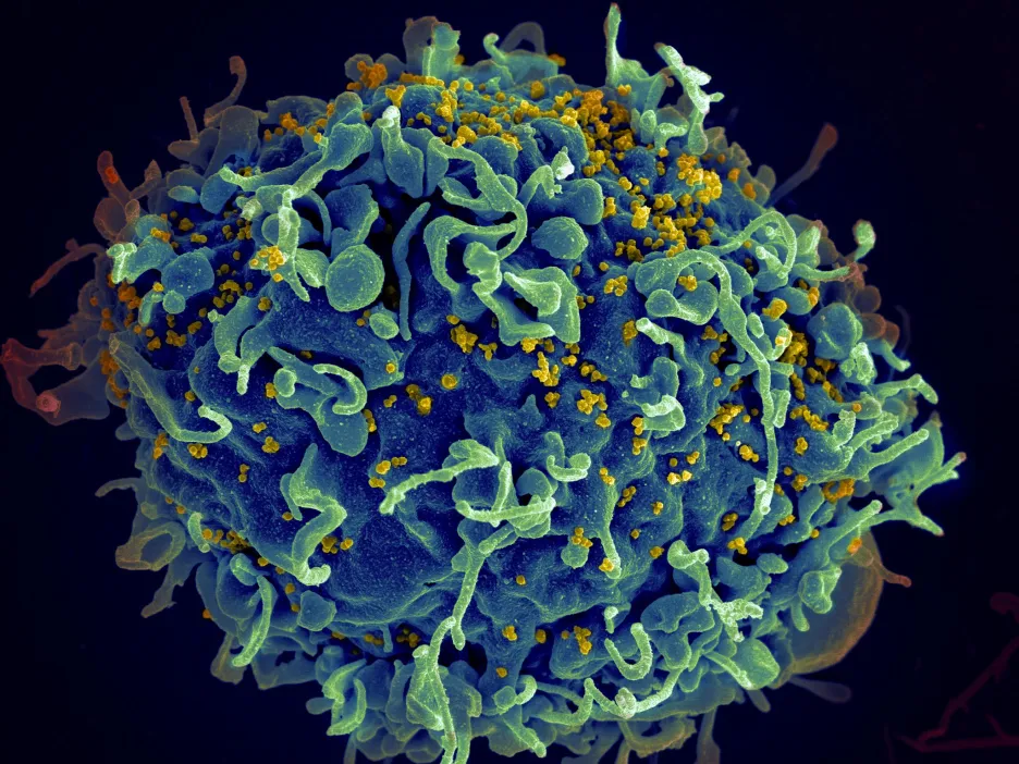 Virus HIV (žlutě) napadá lidskou buňku
