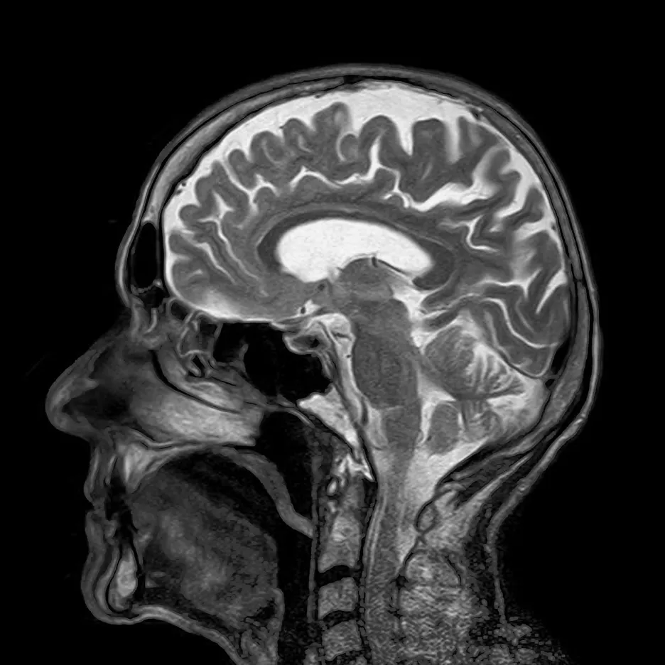 Lidský mozek na MRI