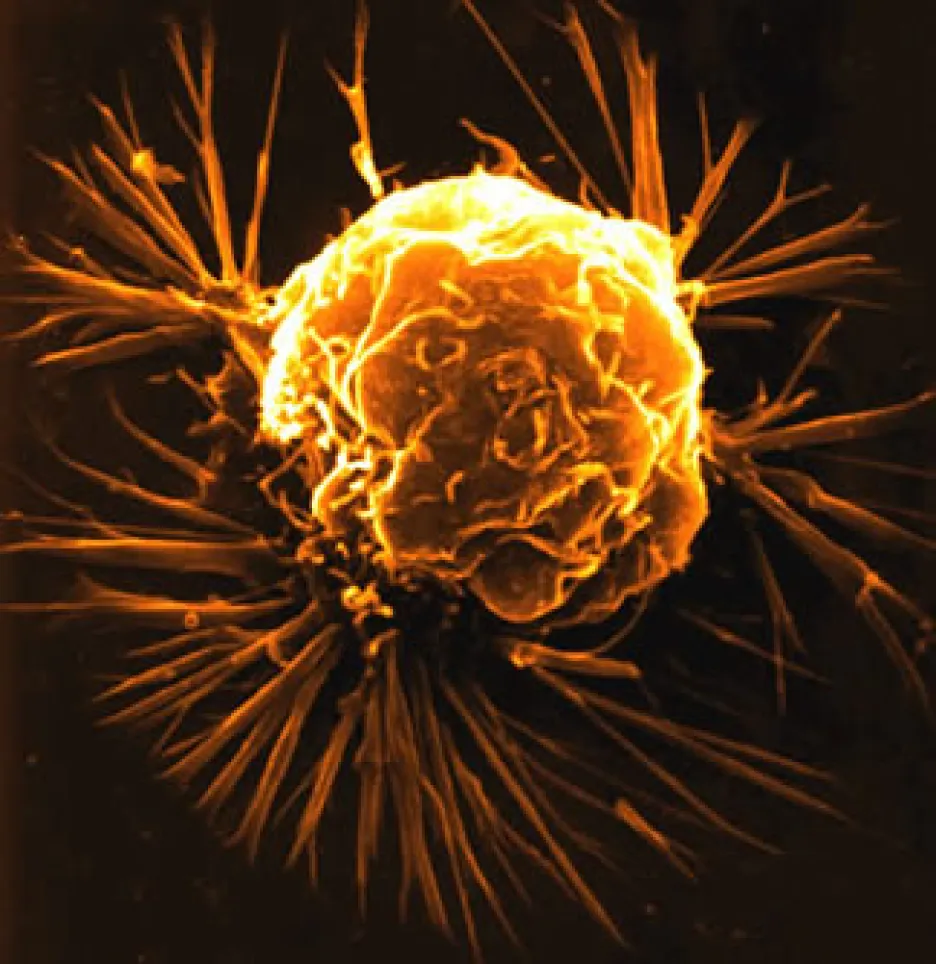Rakovinná buňka prsu