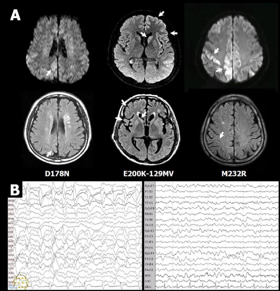 Obraz magnetické rezonance a záznam EEG člověka postiženého Creutzfeldt-Jakobovou nemocí
