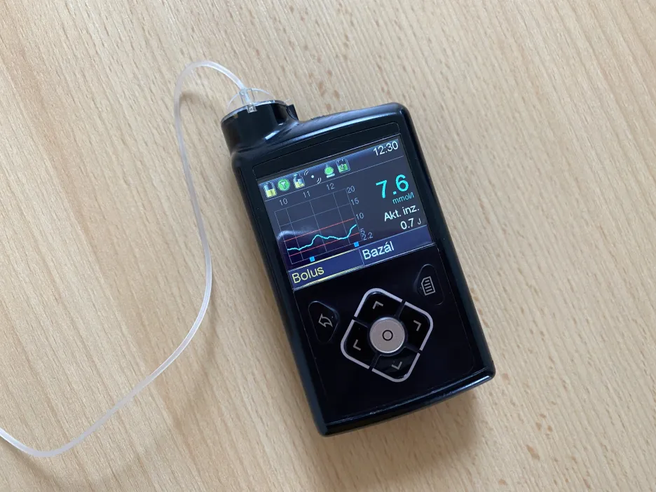 Inzulinová pumpa zobrazující senzorem naměřené hodnoty glykemie