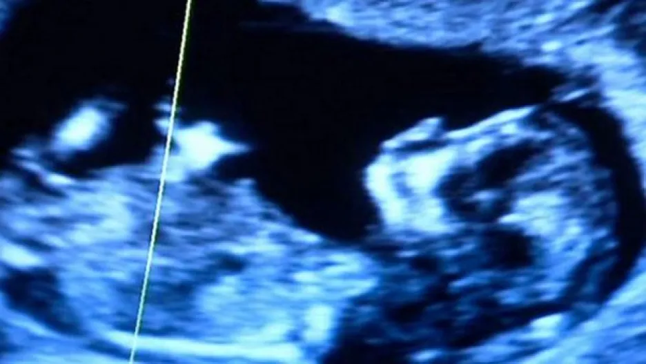 Dítě na ultrazvukovém snímku