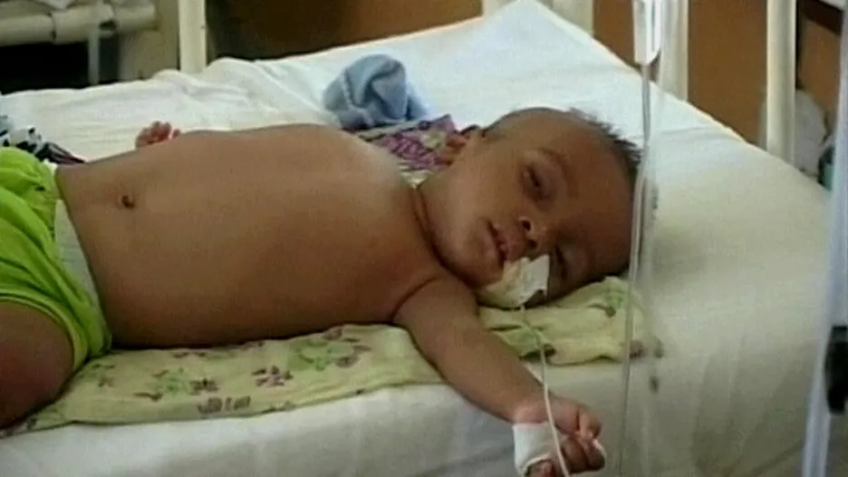Dítě s malárií