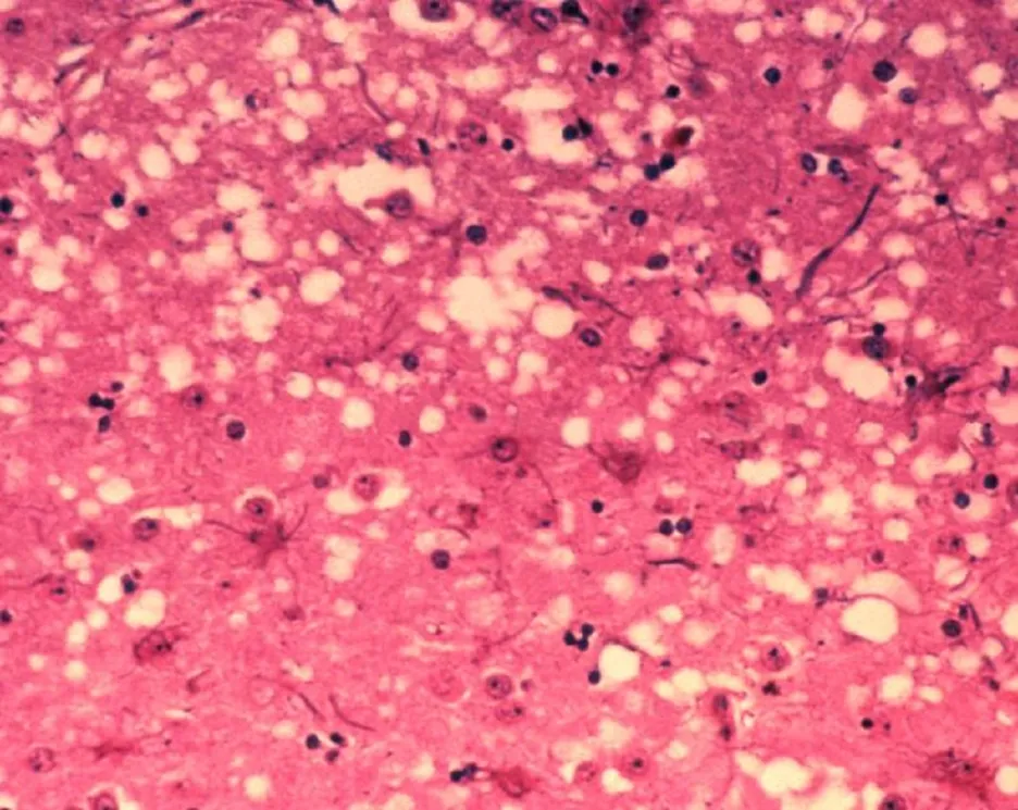 Mozková tkáň krávy postižené BSE