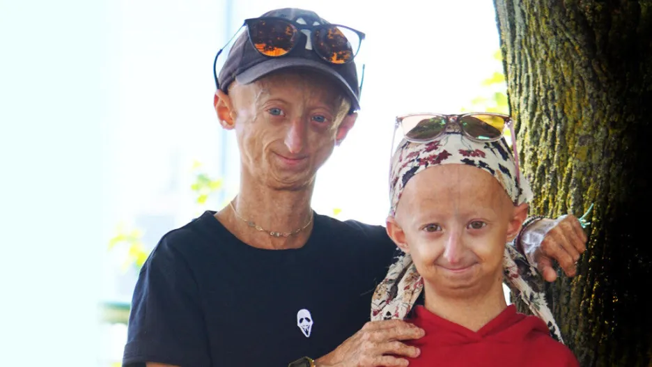 Děti s progerií